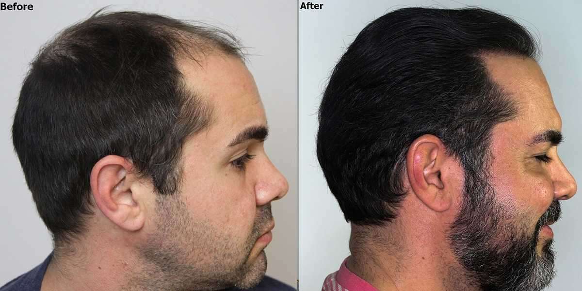 Hair Restoration California