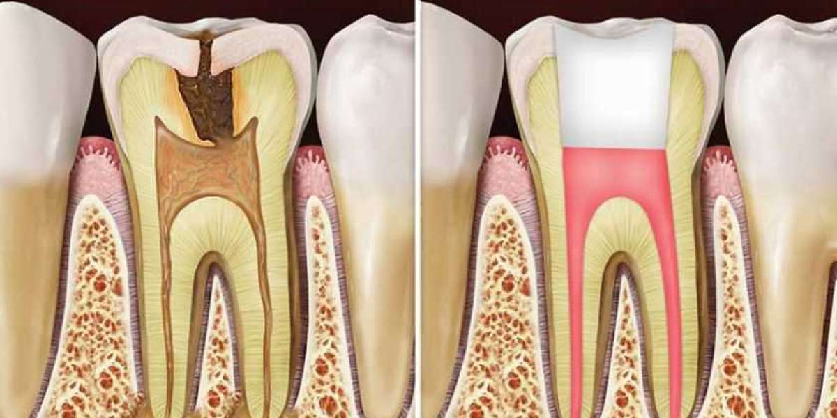 The Role of Antibiotics After Root Canal