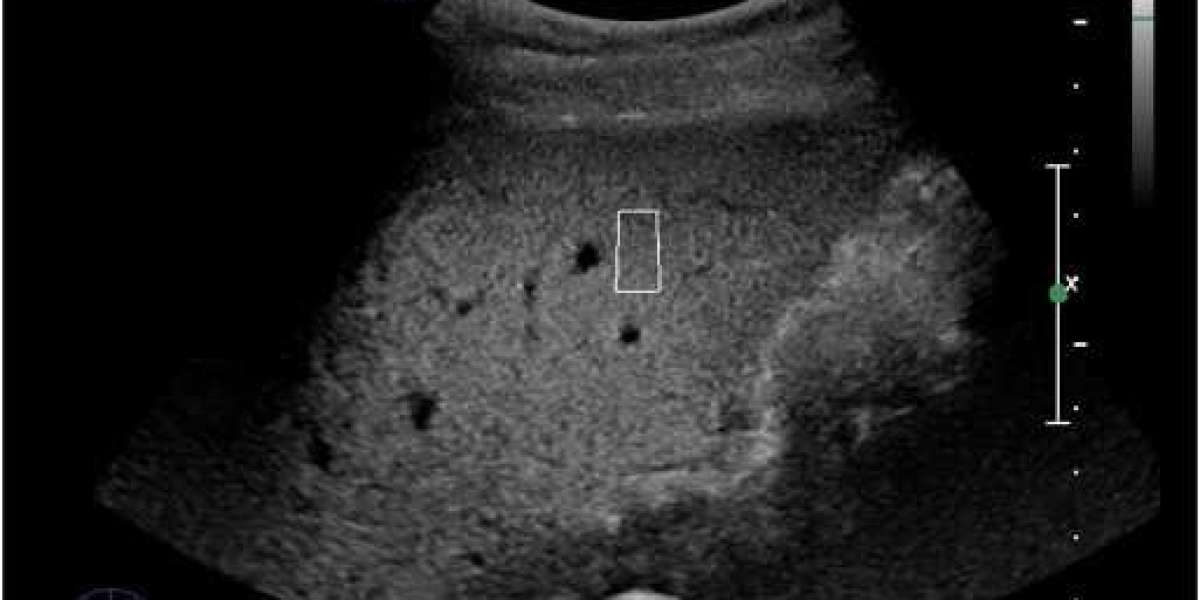 Elastography Imaging Market Trends, Industry Overview, Latest Insights and Forecast 2024-2032