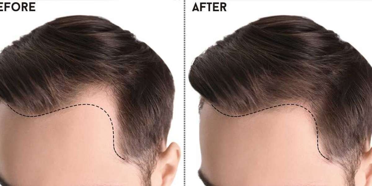 Unlocking Confidence: Discovering the Best Hair Transplant in Pakistan with Hair n Hair
