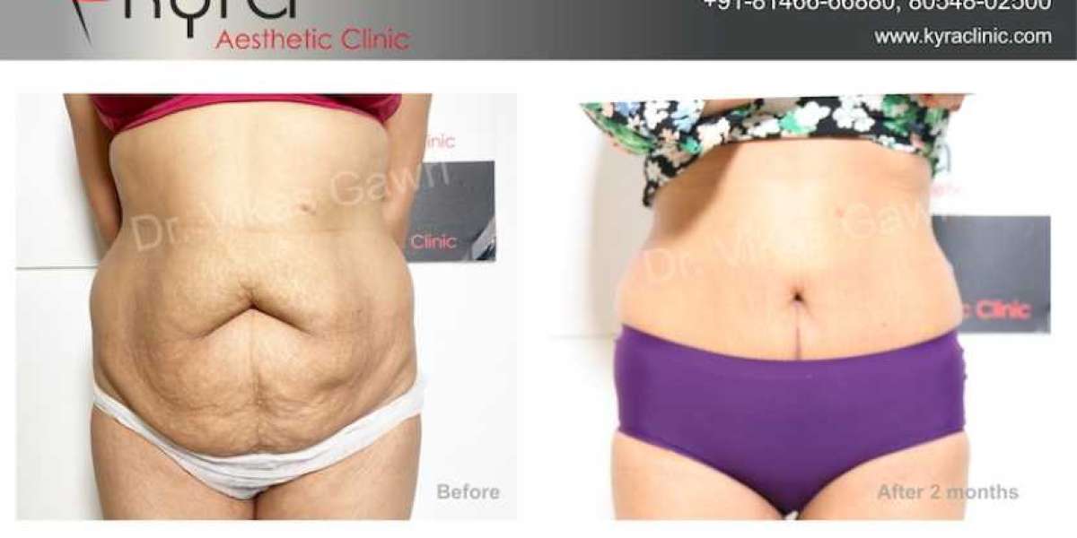 Tummy Tuck Surgery Cost in Punjab