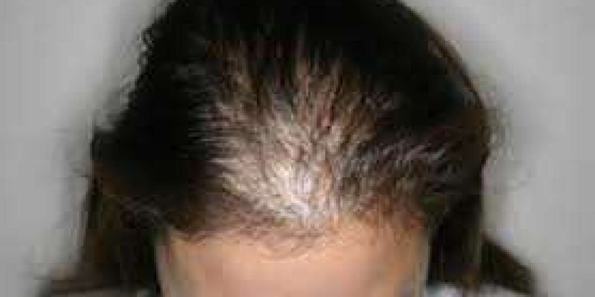 Hair Transplant After Ten Years