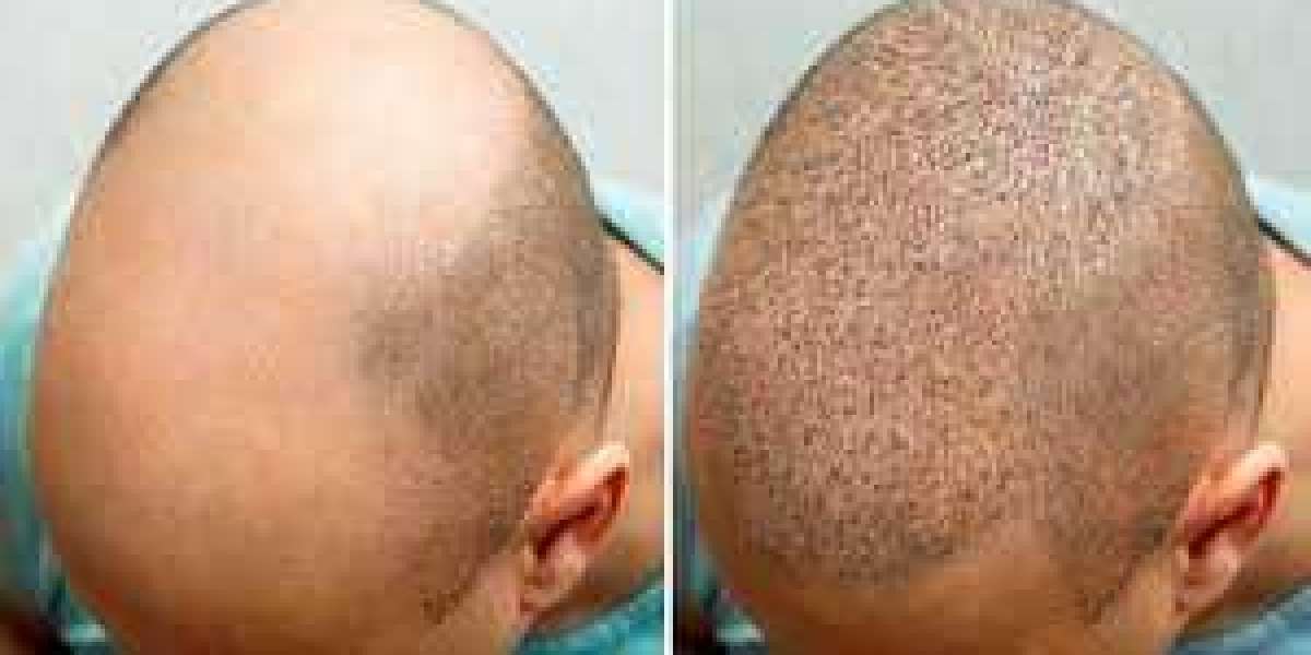 5 popular and advanced hair loss treatments available in Dubai