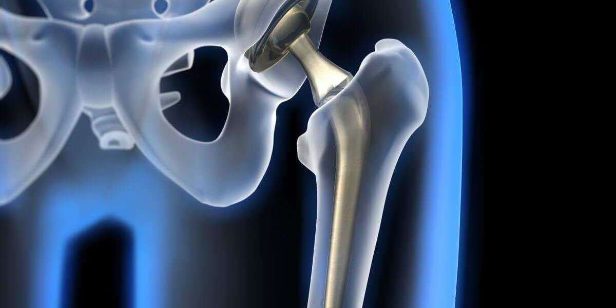 Hip Implants Market By Application, Drive Mechanism and Region Forecasts to 2030